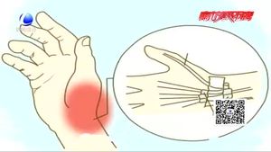 手腕疼痛 當心患上“媽媽手”