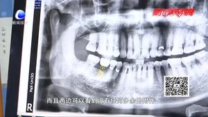 種植牙：讓牙齒重新“長出來”