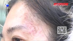 美容差點變毀容 愛美人士需謹慎