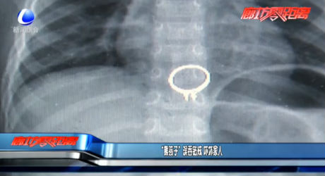 “熊孩子”誤吞鉆戒 嚇壞家人